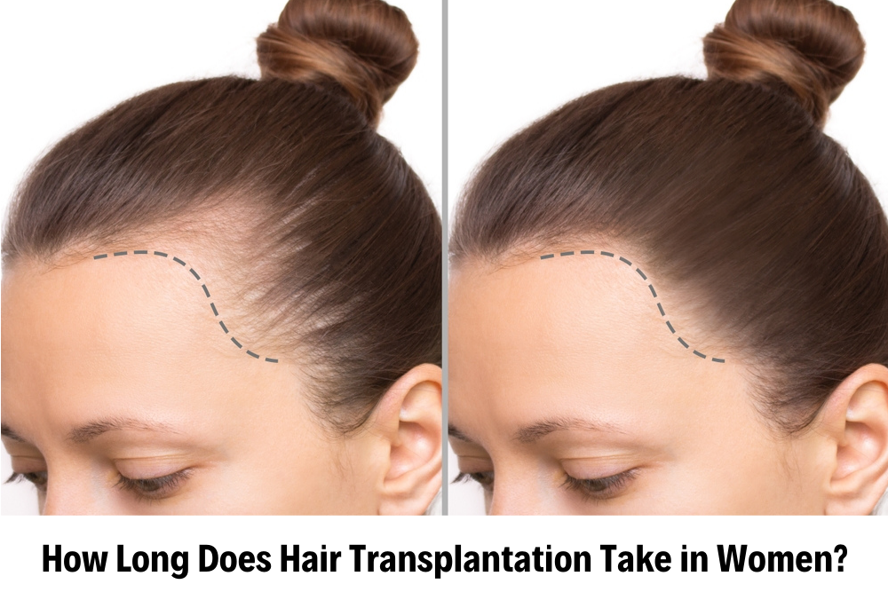 Hair Transplantation for Women